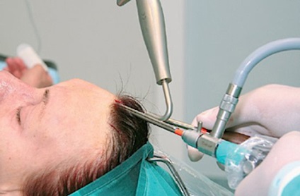 Az endoszkópos arcplasztika - eljárást véleménye, képek és videó