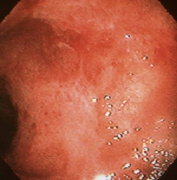 Az eróziós bél colitis kezelésére, a tünetek és az okok