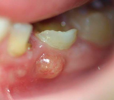 A fluxus az íny - mit kell tenni, hogyan kell kezelni, irányítani fogászat