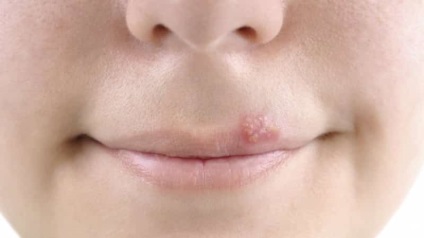 Herpesz kezelése az ajkak, hogyan kell kezelni gyorsan, gyógyszerek