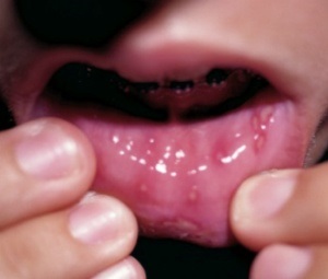 Herpes az ajkak az okok, tünetek, fotó, gyors kezelés gyógyszerek