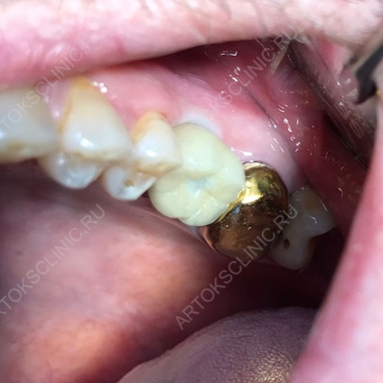 Az implantáció alsó fogak (implantátumok mandibula)