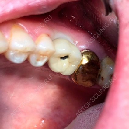 Az implantáció alsó fogak (implantátumok mandibula)