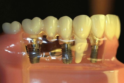 Implantációs alsó fogak szerelése implantátumok a mandibula, fogászatban-stoma, (fogak) Az implantáció az alsó fogak telepíteni implantátum az alsó állkapocs, fogászati al-sztóma