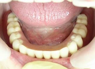 Implantációs alsó fogak szerelése implantátumok a mandibula, fogászatban-stoma, (implantáció mandibula) Az implantáció az alsó fogak telepíteni implantátum az alsó állkapocs, fogászati al-sztóma