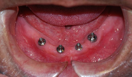Fogászati implantátumok mandibula (implantáció) Beültetés állkapcsi fogak