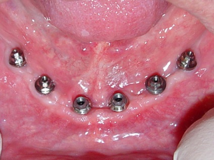 Beültetés állkapcsi fogak