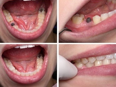 Fogászati implantátumok a mandibula (alsó) Beültetés állkapcsi fogak