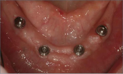 Fogászati implantátumok a mandibula (alsó) Beültetés állkapcsi fogak