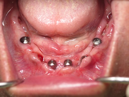 Fogászati implantátumok a mandibula (alsó) Beültetés állkapcsi fogak
