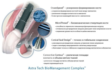 Implantátumok astra tech (Astra Tech) típusú, a technológia, valódi előnyöket, az ár