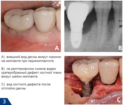 Az implantátumok és a dohányzás - nem szívok műtét előtt vagy után, a hatásait