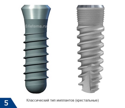 Az implantátumok és a dohányzás - nem szívok műtét előtt vagy után, a hatásait