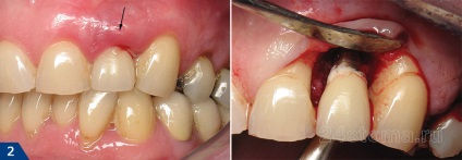 Az implantátumok és a dohányzás - nem szívok műtét előtt vagy után, a hatások (lehetséges) Az implantátumok és a dohányzás - nem szívok műtét előtt vagy után, a hatásait