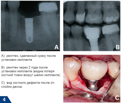 Az implantátumok és a dohányzás - nem szívok műtét előtt vagy után, a hatásait