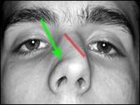 Görbülete az orr - okai, tünetei, diagnózisa és kezelése