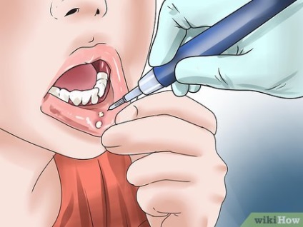 Hogyan kell kezelni afta vagy fekélyek a szájban