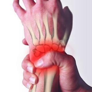 kezek osteoarthritisének kezelése