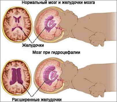 Hogyan állapítható meg, agy-gerincvelői folyadék az orrából egy kisgyermek traumás bazális liquorrhea, és te nem