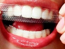 Hogyan fehéríti a fogakat otthon anélkül, hogy kárt
