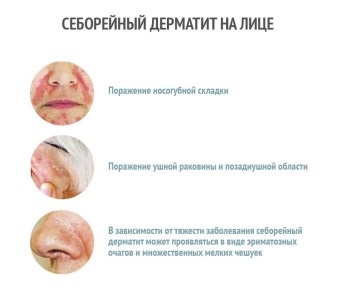 Hogyan lehet felismerni egy élvezet seborrhoeás dermatitis az arcon