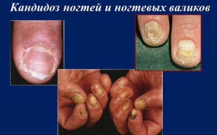 nail gomba a lábak kezelésére propolis)