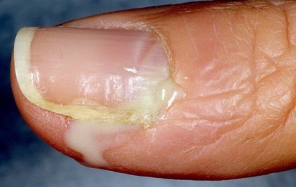 Candidiasis körmök (gomba) és a bőr kezelésére