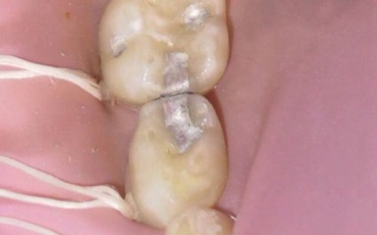 A fogszuvasodás az elülső fogak okoz, diagnózis, kezelés
