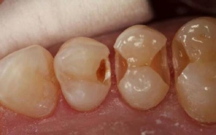 A fogszuvasodás az elülső fogak okoz, diagnózis, kezelés