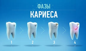 Fogszuvasodás, anélkül, hogy károsítaná a világon (irány tartalmazza magam) Fogszuvasodás, a világ anélkül, hogy kárt