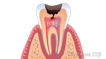 A fogszuvasodás lehet fordítani, vagy azt, hogy nem tud a fogak