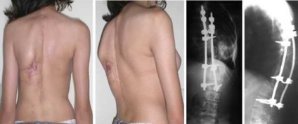 háti gerinc kifoszkoliózis azaz formák, jelek (emlő) Kyphoscoliosis mellüreg azaz formák, jelek