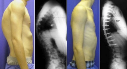 háti gerinc kifoszkoliózis azaz formák, jelek (emlő) Kyphoscoliosis mellüreg azaz formák, jelek