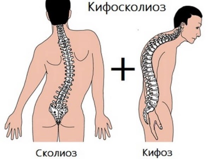 háti gerinc kifoszkoliózis azaz formák, jelek (kifoszkoliózis) Kyphoscoliosis mellüreg azaz formák, jelek