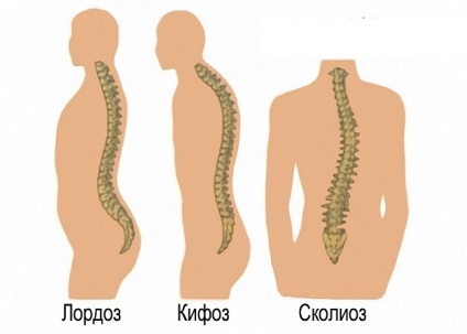 Kyphosis, lordosis és gerincferdülés - ellentétben a betegségek (súlyos esetekben scoliosis) Kyphosis, lordosis és scoliosis - ellentétben azzal, amit betegségek