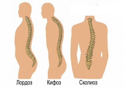 Kyphosis, lordosis és scoliosis - ellentétben azzal, amit betegségek