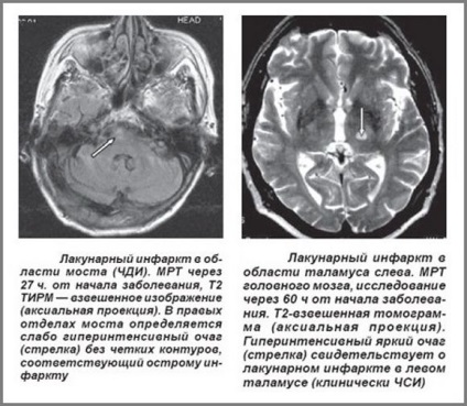A komputertomográfia (CT) az agy a stroke (képalkotó) A komputertomográfia (CT) az agy agyvérzés