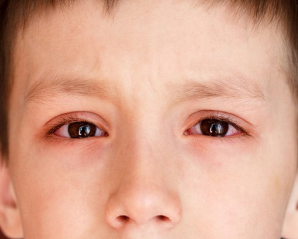 Kötőhártya gyermekek tünetek, panaszok okai, fotó