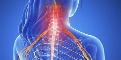 Radicularis szindróma, nyaki gerinc a tünetek, a kezelés