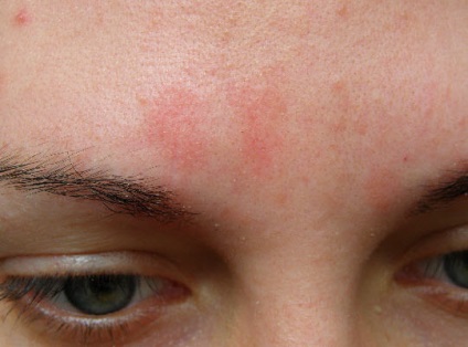 miért vannak vörös foltok az arcon és hámlik borz zsír és pikkelysömör kezelése