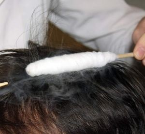 Cryo fej - egy egyszerű megoldás a hajhullás problémája