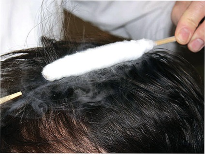 Krioterápia kezelésére haj folyékony nitrogénnel