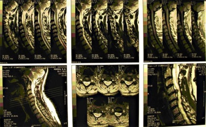 CT a gerinc - a modern diagnosztikai eljárás