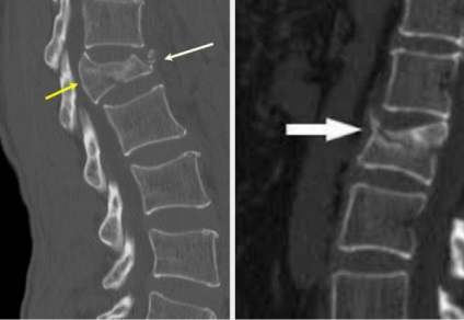 CT a gerinc - a modern diagnosztikai eljárás