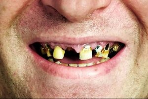 A dohányzás a beültetés után a fogak