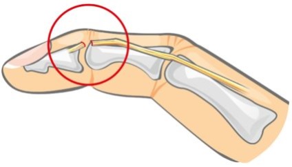Az oszteoartritisz kezelése arra a kis ízületek a kéz és a betegségmegelőzés (ízületek) Az osteoarthritis kezelésére a kis ízületek a kéz és a betegségek megelőzése
