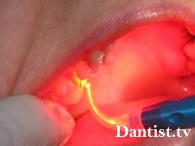 fogat ciszták lézeres kezelés ár és fotó (odontectomy ciszták lézer) fogat ciszták lézeres kezelés ár és fotók
