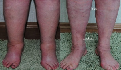 Kezelés lymphostasis lábak - központ phlebológiai Dr. Savinov (láb) Kezelés lymphostasis lábak - központ phlebológiai Dr. Savinov