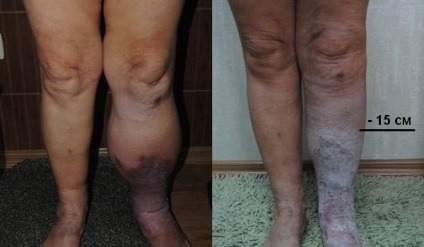 Kezelés lymphostasis lábak - központ phlebológiai Dr. Savinov (központ) Kezelés lymphostasis lábak - központ phlebológiai Dr. Savinov