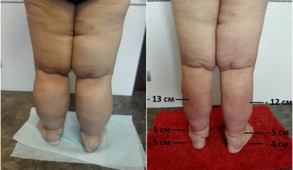 Kezelés lymphostasis lábak - központ phlebológiai Dr. Savinov (phlebológiai) Kezelés lymphostasis lábak - központ phlebológiai Dr. Savinov